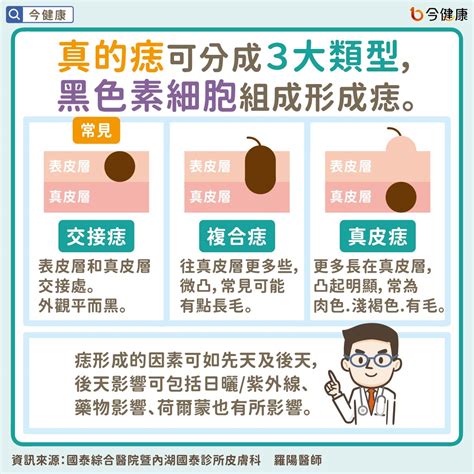 臉上突然長痣怎麼辦|是痣？皮膚癌？還是什麼？常見Q&A解惑！醫教揪出「。